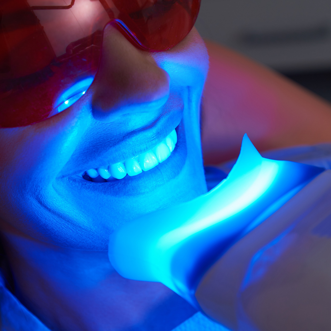 Brighter Smiles Home Whitening Starter Kit