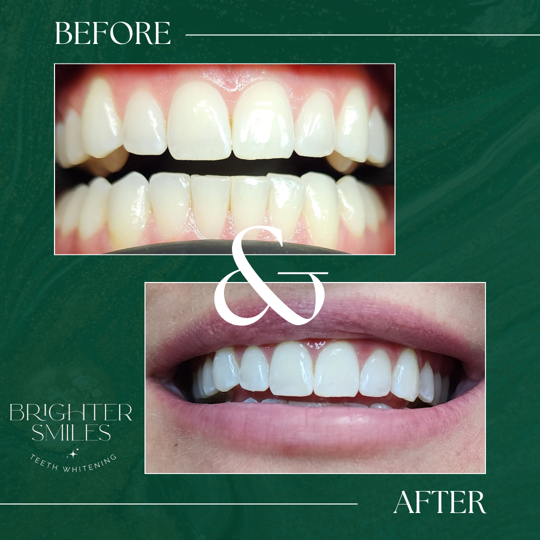 Brighter Smiles Home Whitening Kit Refill Pack