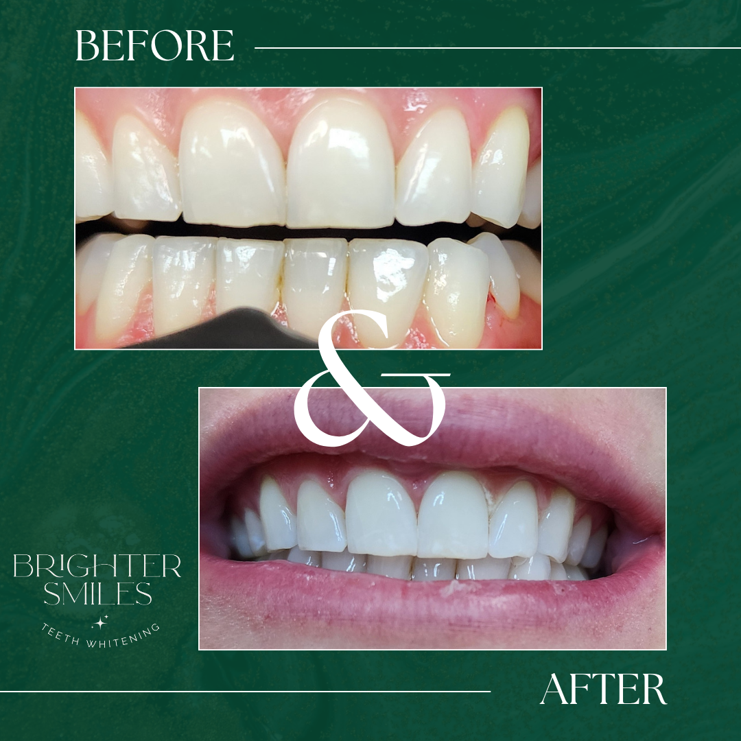 Brighter Smiles Home Whitening Kit Refill Pack