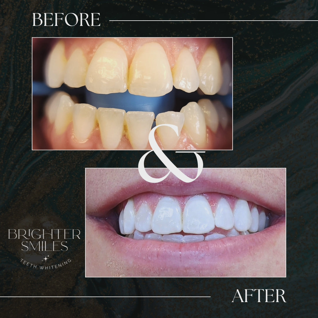 Brighter Smiles Home Whitening Starter Kit