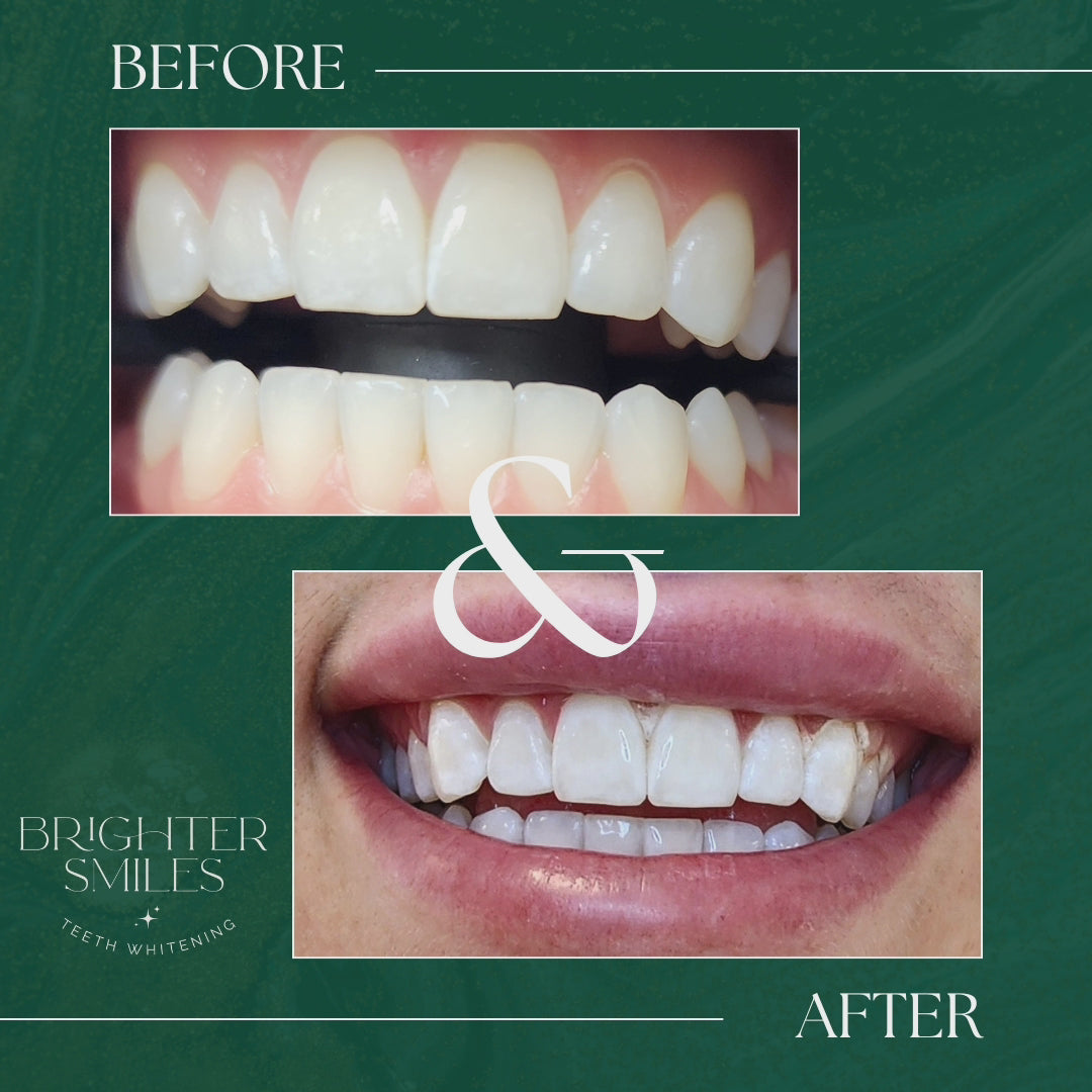 Brighter Smiles Home Whitening Starter Kit