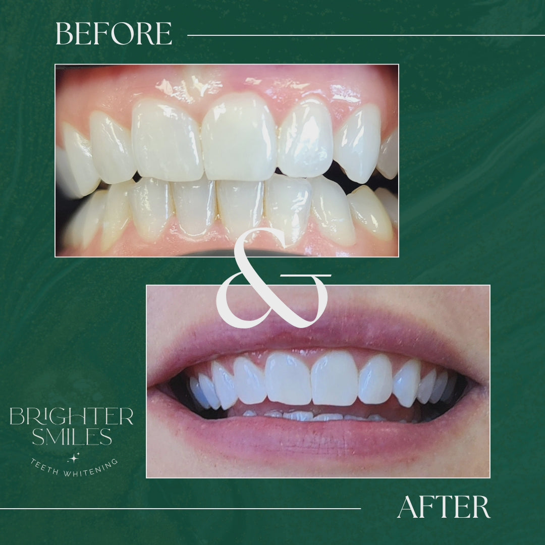 Brighter Smiles Home Whitening Starter Kit