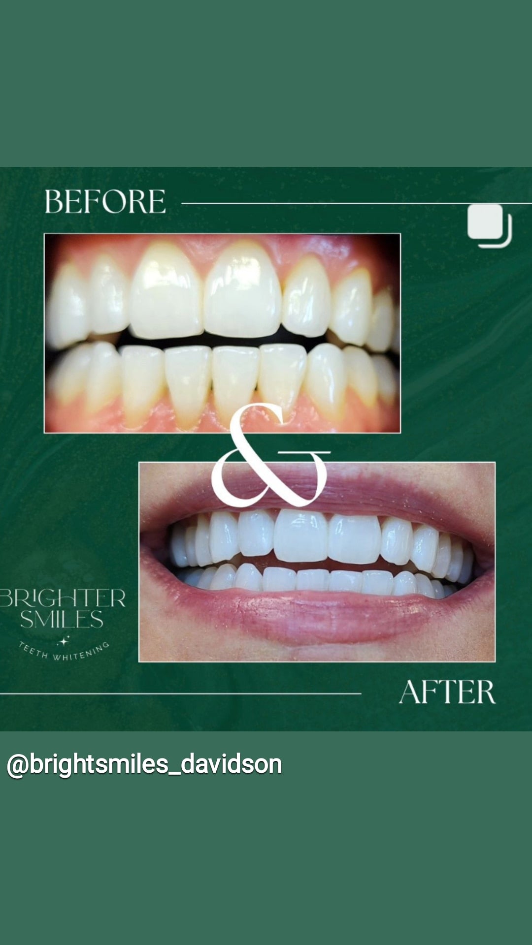 Brighter Smiles Home Whitening Starter Kit
