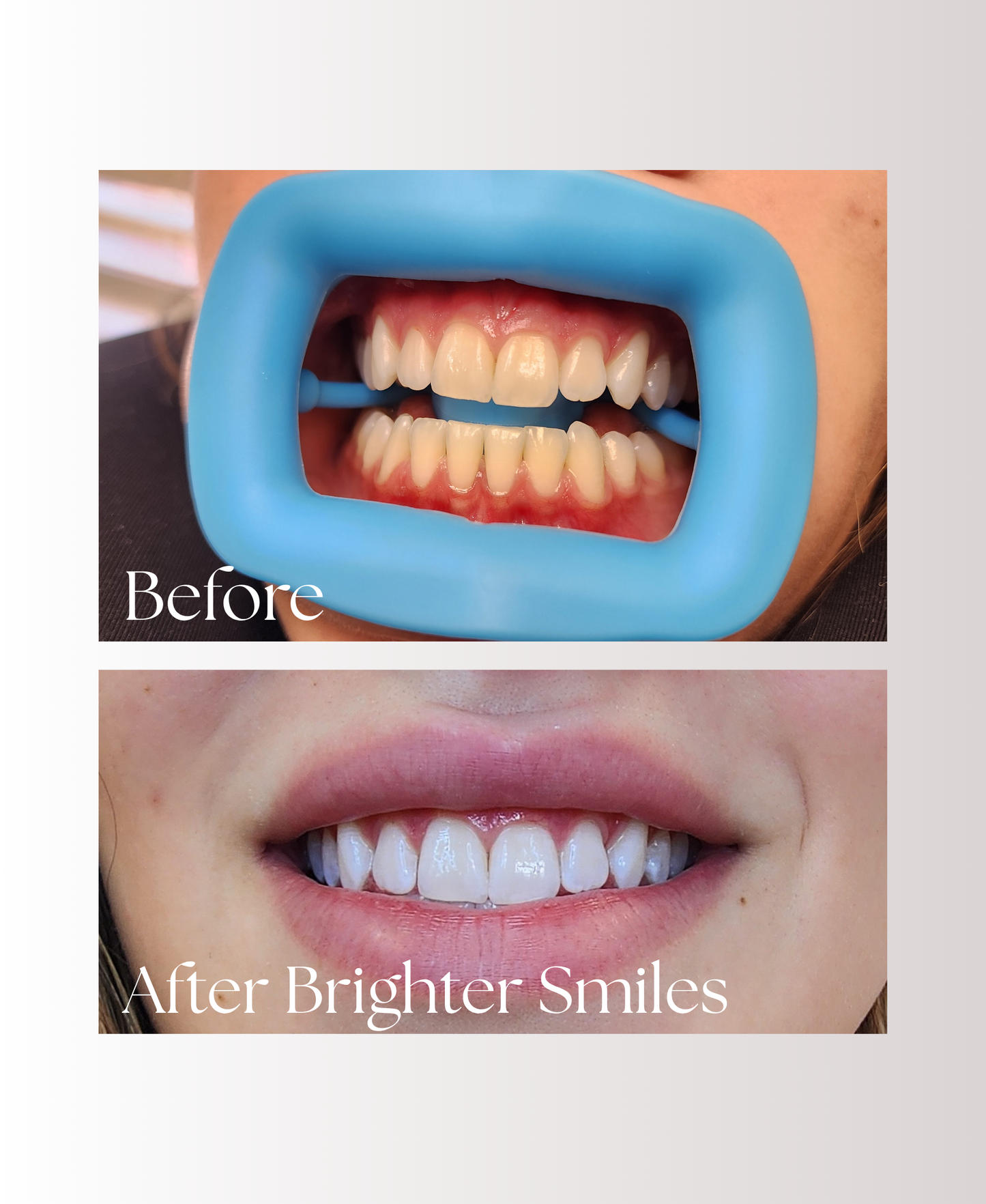 Advanced Home Whitening System Refill Pack