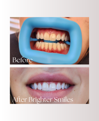 Advanced Home Whitening System Refill Pack