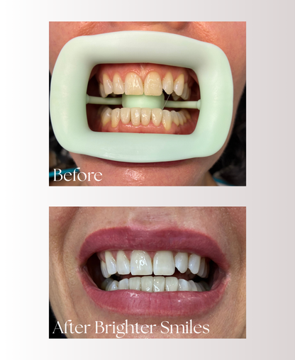 Advanced Home Whitening System Refill Pack