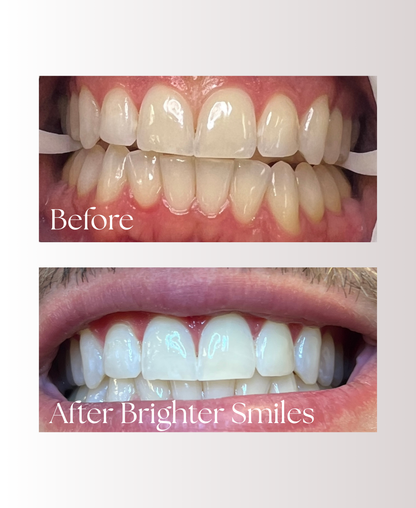 Advanced Home Whitening System Refill Pack