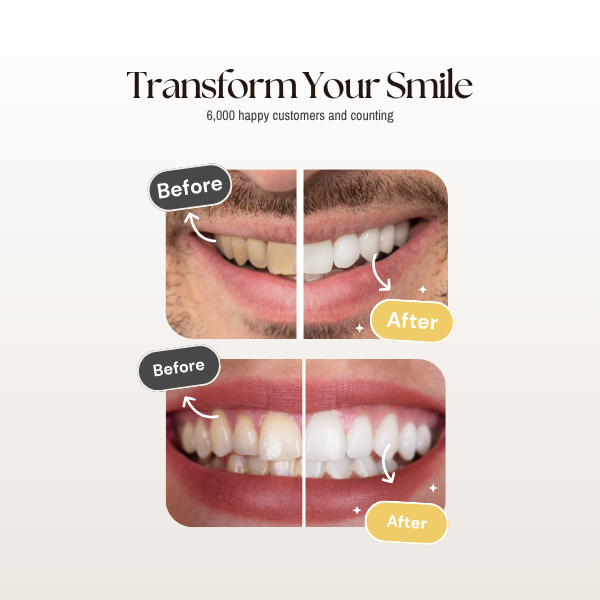 At-Home Teeth Whitening System