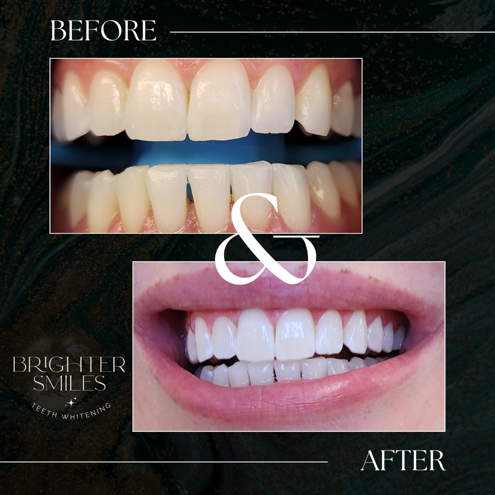 Teeth whitening before and after comparison with 'Brighter Smiles' branding.
