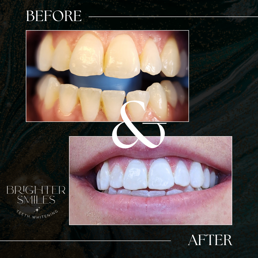 Before and after comparison of teeth whitening with 'Brighter Smiles' branding