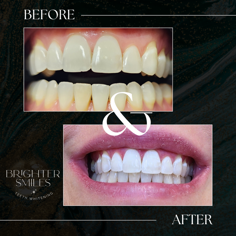 Before and after comparison of teeth whitening with a visible 'Brighter Smiles' logo.