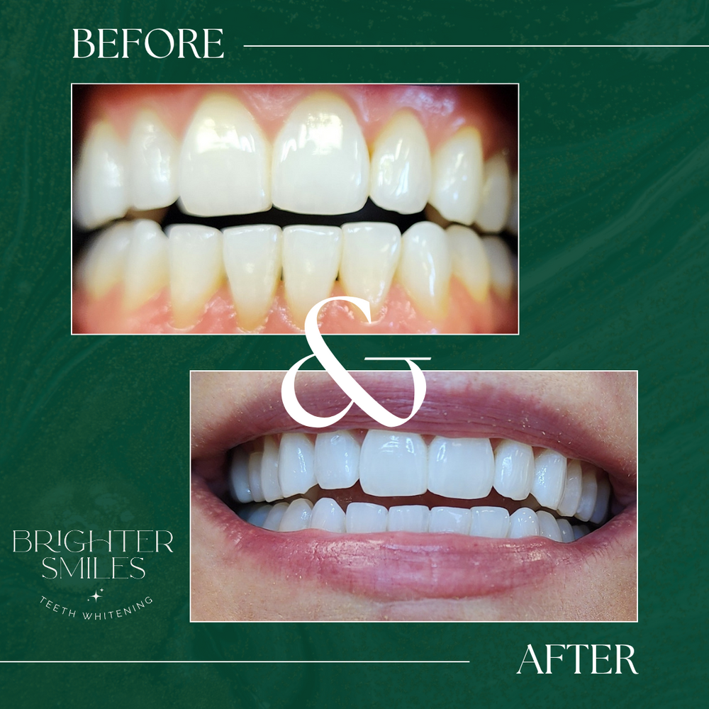 Before and after teeth whitening comparison with 'Brighter Smiles' branding on a green background.