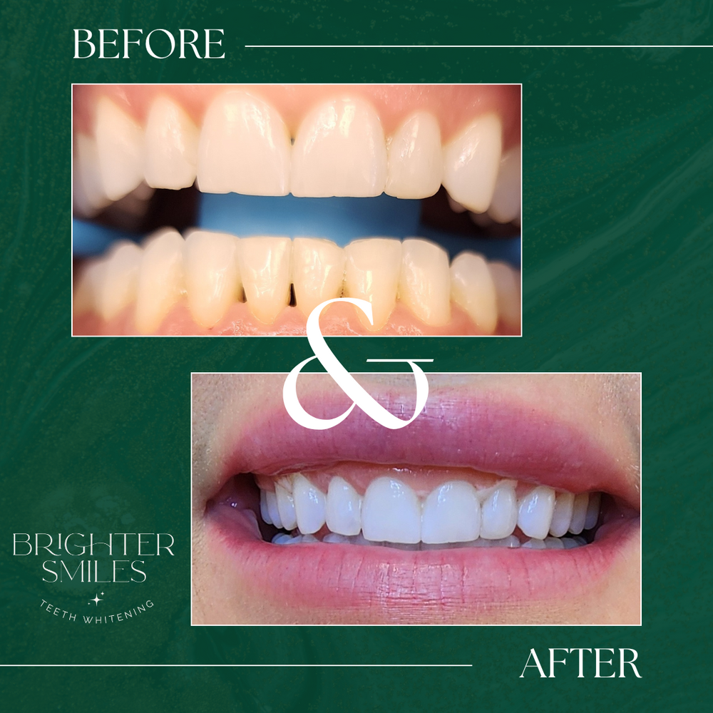 Before and after teeth whitening comparison with 'Brighter Smiles' branding on a green background.