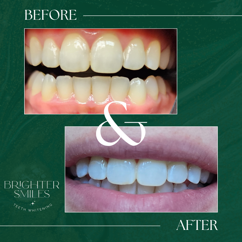 Before and after teeth whitening comparison with 'Brighter Smiles' branding on a green background.