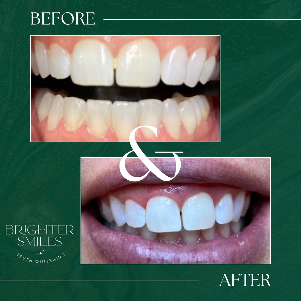 Before and after teeth whitening comparison with 'Brighter Smiles' branding on a green background.