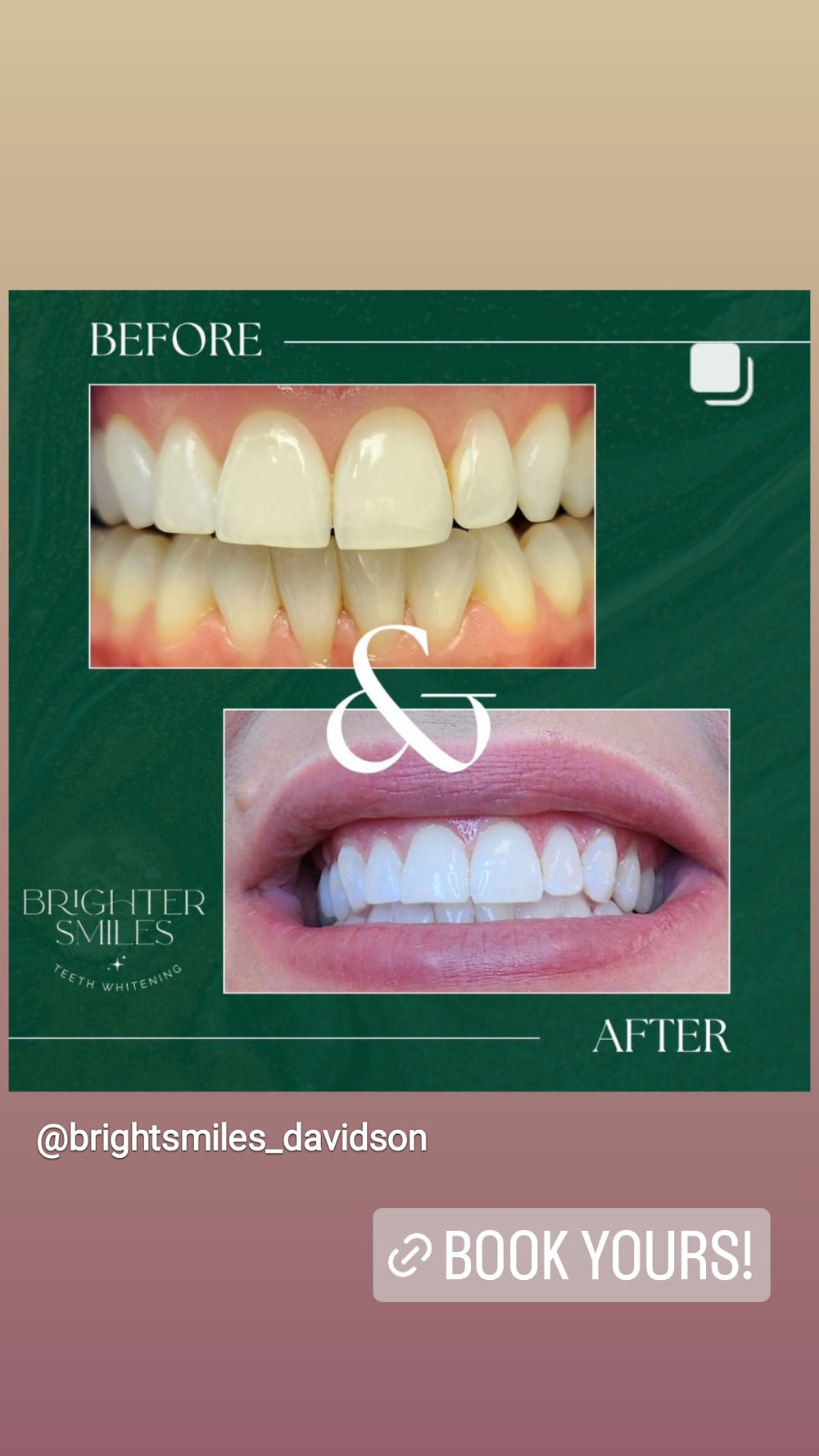 Before and after dental treatment comparison with promotional text on a green border.