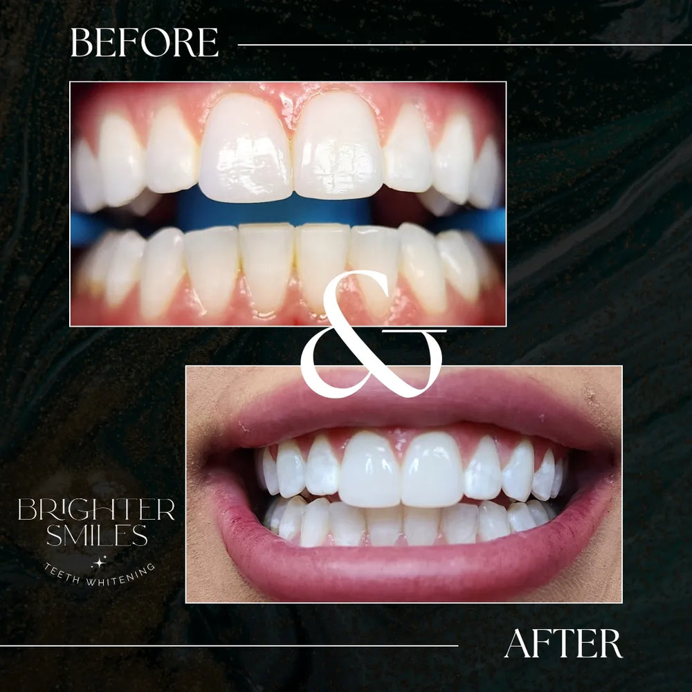Before and after comparison of teeth whitening with 'Brighter Smiles' branding.