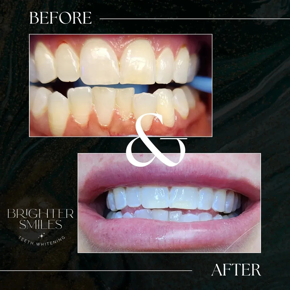 Before and after teeth whitening comparison with 'Brighter Smiles' branding.
