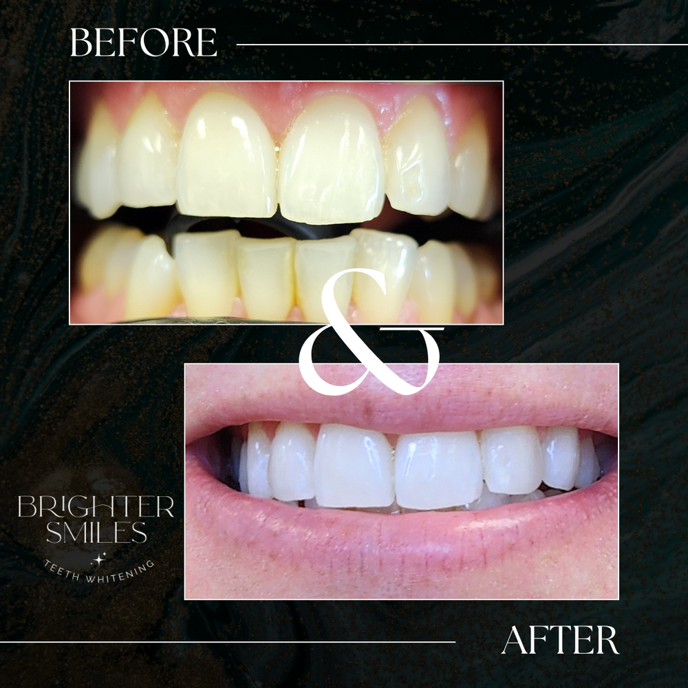 Before and after comparison of teeth whitening with 'Brighter Smiles' branding.
