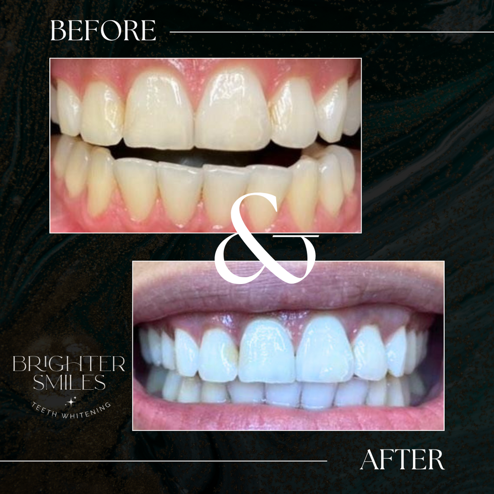 Before and after comparison of teeth whitening with a white '&' symbol in the center.