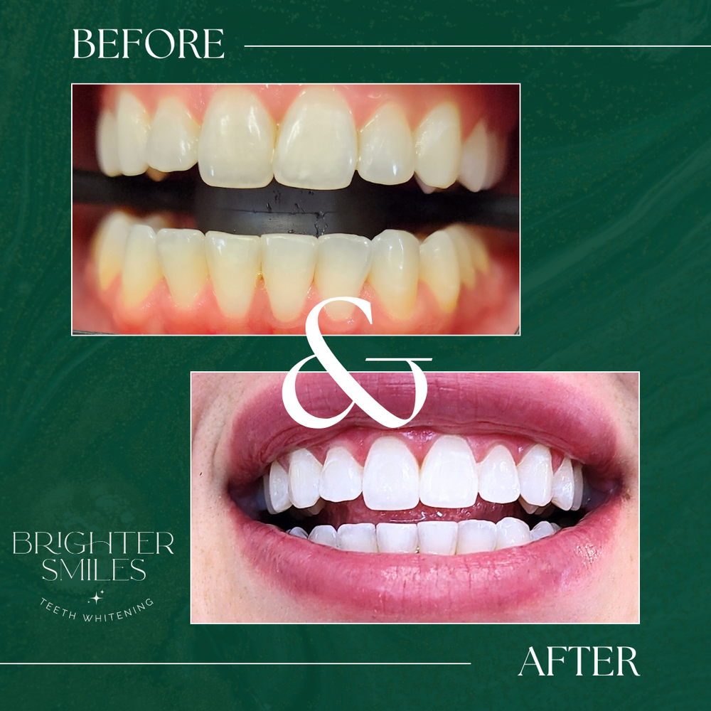 Before and after teeth whitening comparison with 'Brighter Smiles' branding on a green background.