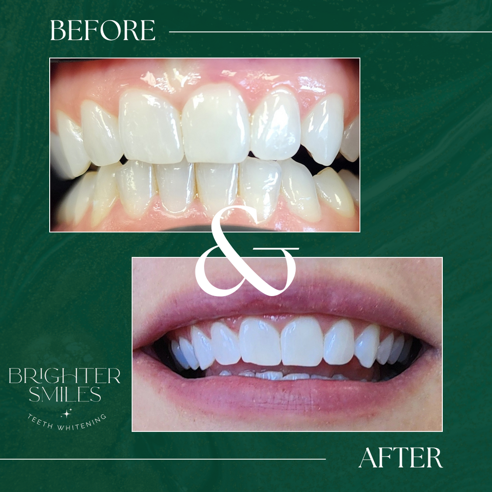 Before and after teeth whitening comparison with 'Brighter Smiles' branding on a green background.